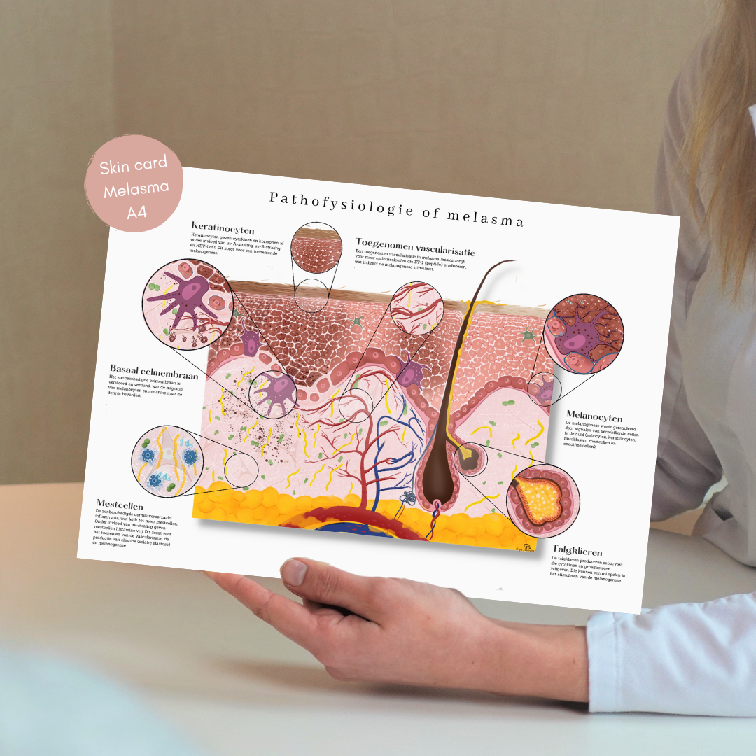 Melasma huidkaart: gedetailleerde anatomische pathofysiologie - educatief hulpmiddel