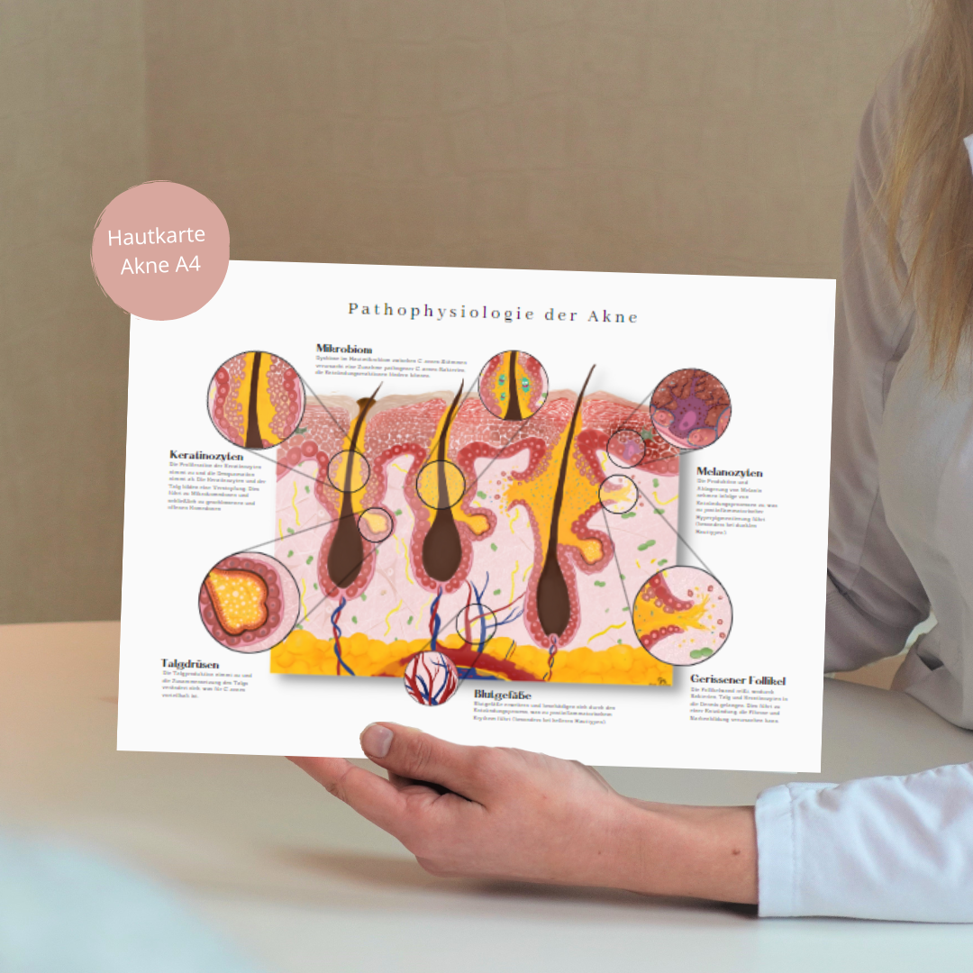 Acne huidkaart: gedetailleerde anatomische pathofysiologie - educatief hulpmiddel