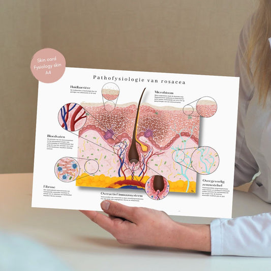 Rosacea huidkaart: gedetailleerde anatomische pathofysiologie - educatief hulpmiddel