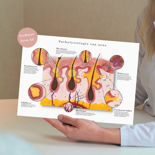Acne huidkaart: gedetailleerde anatomische pathofysiologie - educatief hulpmiddel