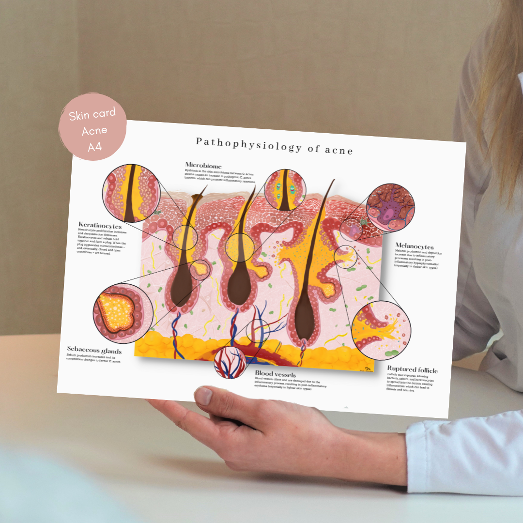 Acne huidkaart: gedetailleerde anatomische pathofysiologie - educatief hulpmiddel